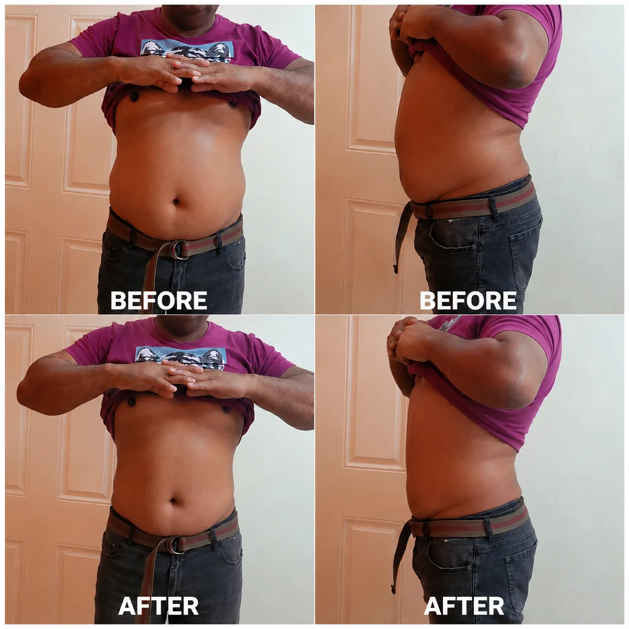 Skin Tightening Results before and after