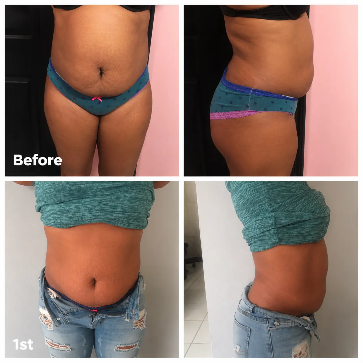 Body Contouring Results before and after