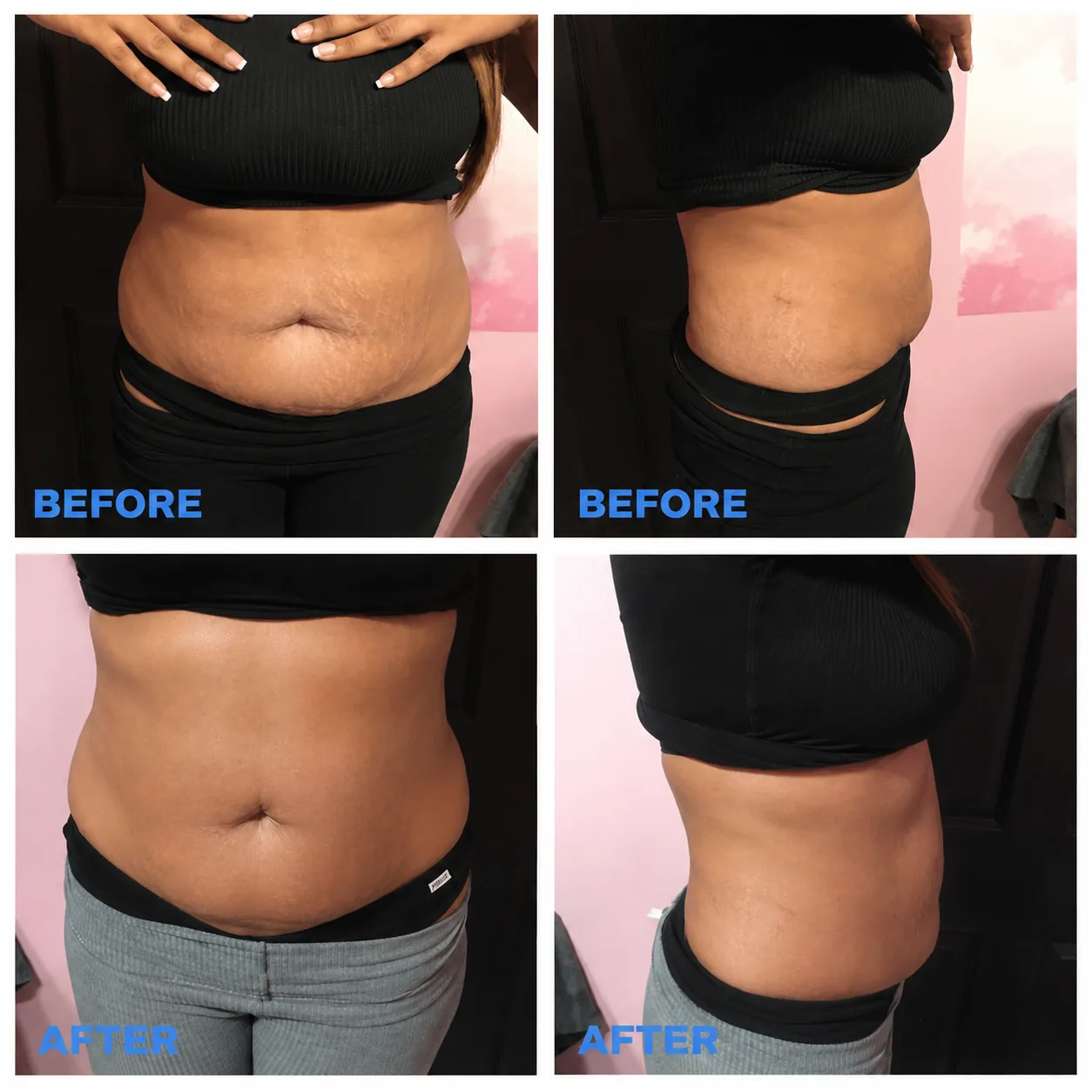 Skin Tightening Results before and after
